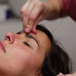 Depilación labio mentón en Clínica KOA Valencia para una piel suave y sin vello