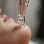 Microneedling con Exosomas