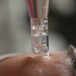 Microneedling 5 sesiones