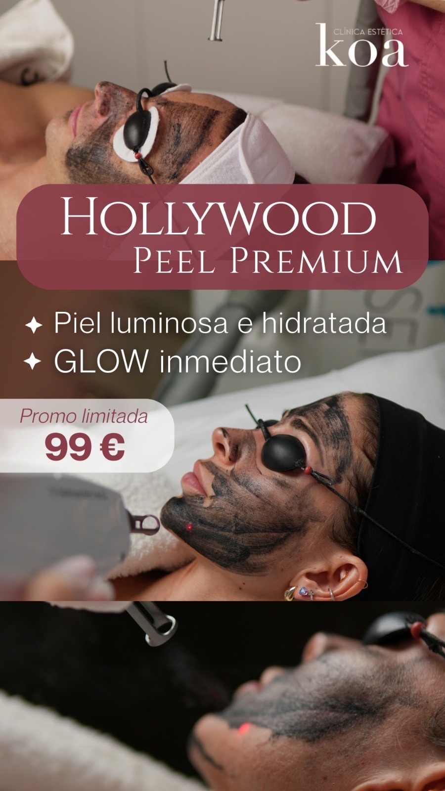Promoción – Tratamiento de Hollywood Peel Premium