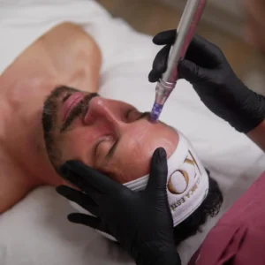 Microneedling personalizado