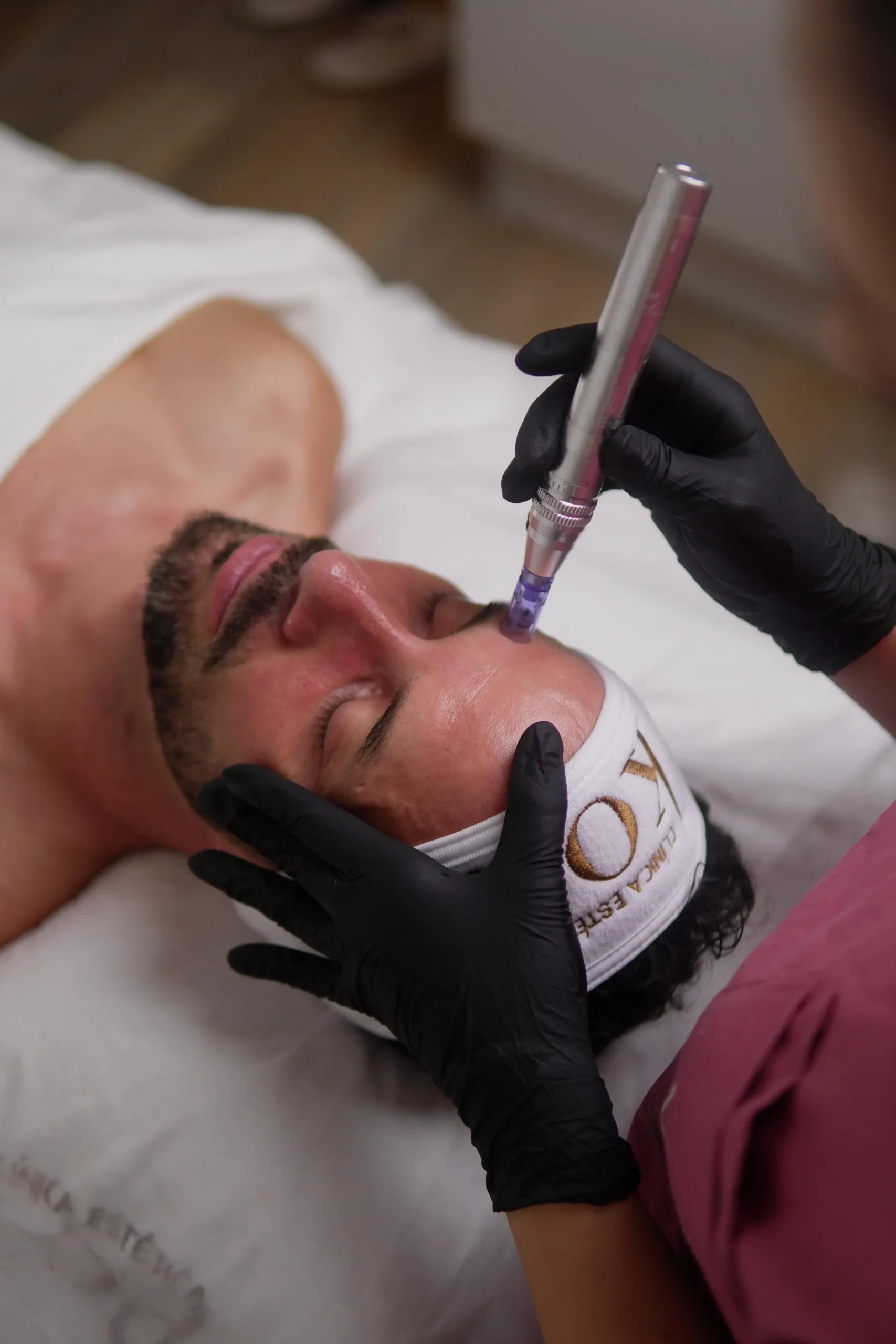 microneedling-personalizado