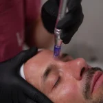 Pack 3 sesiones Peeling + Microneedling