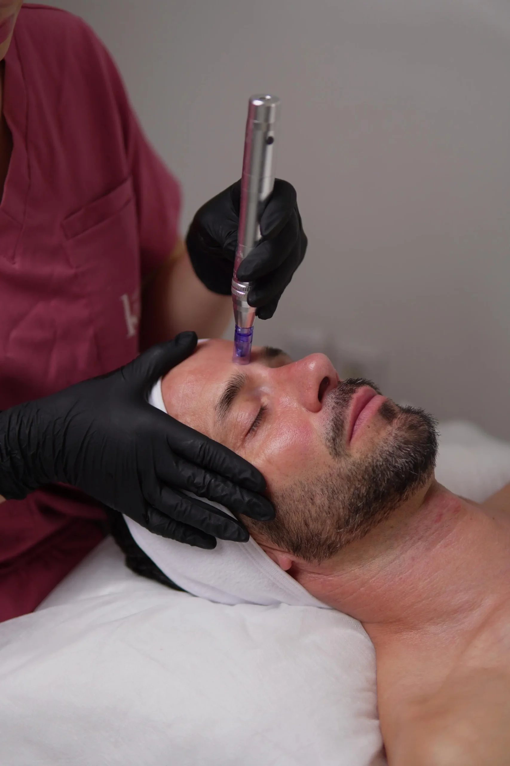 peeling-microneedling