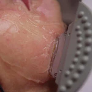 Peeling químico + IPL luminosidad