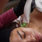 Radiofrecuencia Fraccionada Pack 2 sesiones