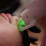 Radiofrecuencia Fraccionada Pack 3 sesiones