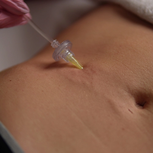 Aplicación de carboxiterapia corporal con microinyección en abdomen en Clínica Koa Valencia