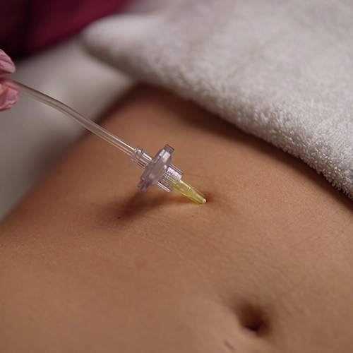 Carboxiterapia corporal en abdomen para tratar celulitis y flacidez en Clínica Koa Valencia