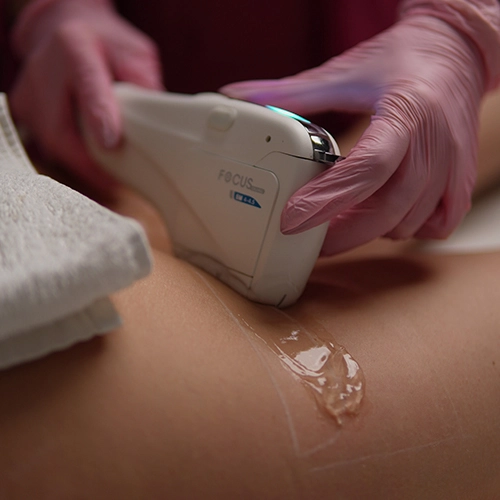 HIFU corporal en abdomen con ultrasonidos focalizados para reducir grasa localizada en Valencia