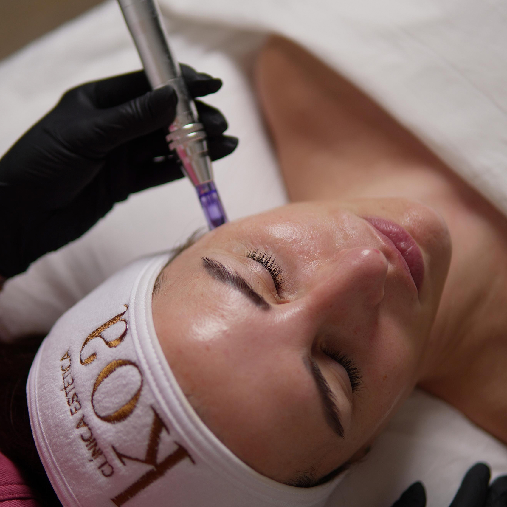 pack-3-sesionesde-microneedling-con-exosomas