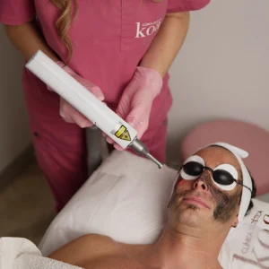 Hollywood peel
