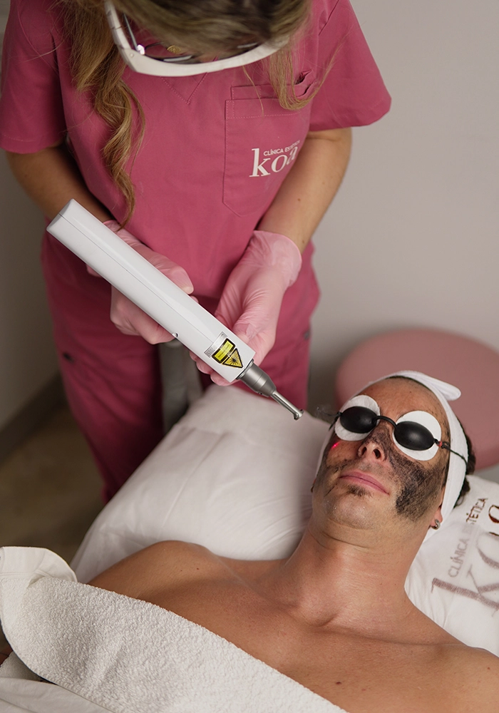 Hollywood peel con láser y máscara de carbón en Clínica KOA Hollywood peel con láser y máscara de carbón en Clínica KOA
