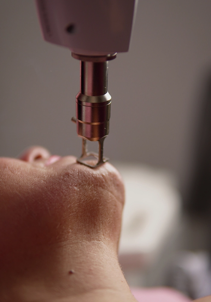 Laser Ablativo y Fraccionado Erbio:YAG aplicado en tratamiento facial en cabina