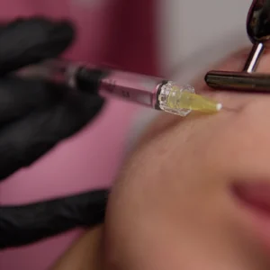 Mesoterapia facial