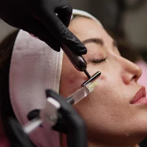 Relleno de ojeras con acido hialurónico Redesensity 2
