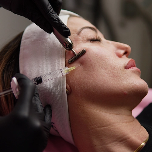 Aplicación de Relleno de pómulos con ácido hialurónico Ultradeep para realzar y redefinir los pómulos en Clínica KOA.